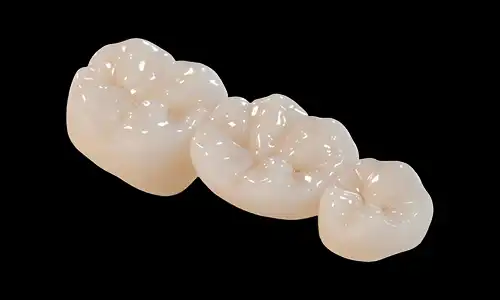 How White Gold PFM Improves Crown Durability in Long-Term Restorations